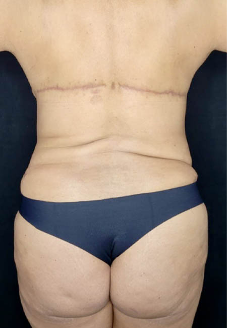 Tummy Tuck case #3099