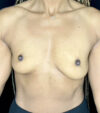 Breast Augmentation case #4748