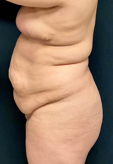 Butt Lift case #4673