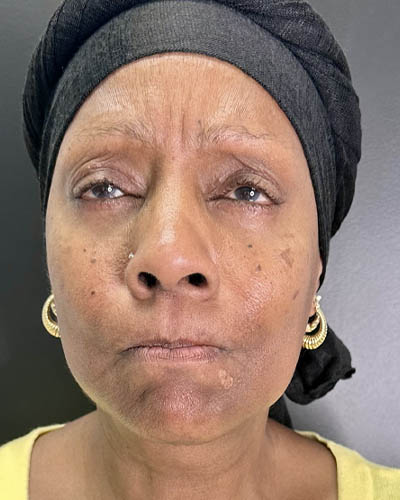 Facial Rejuvenation case #4879