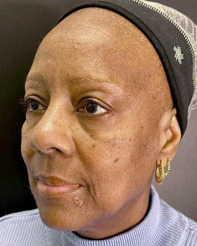 Facial Rejuvenation case #4879