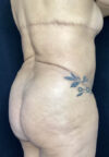 Butt Lift case #4673