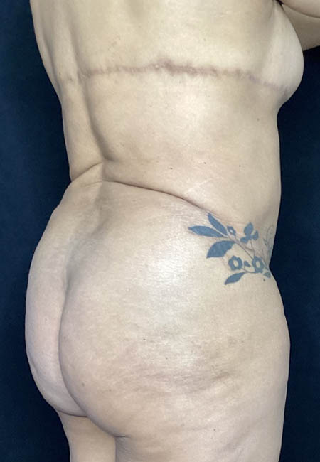 Butt Lift case #4673
