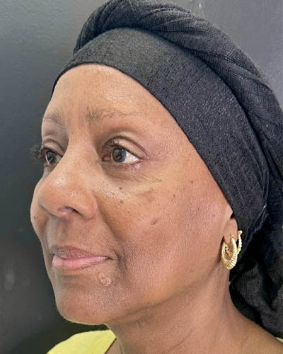 Facial Rejuvenation case #4879