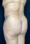 Butt Lift case #4673