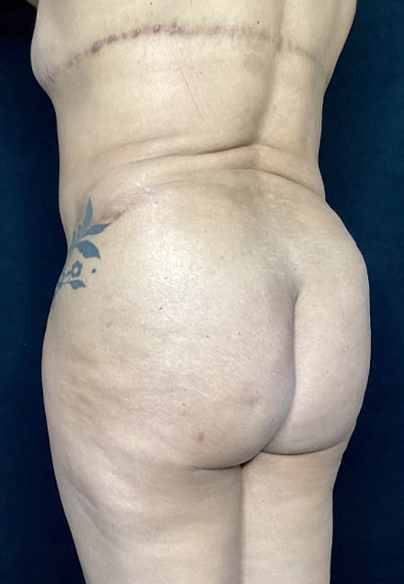 Butt Lift case #4673