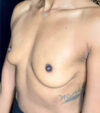 Breast Augmentation case #4748
