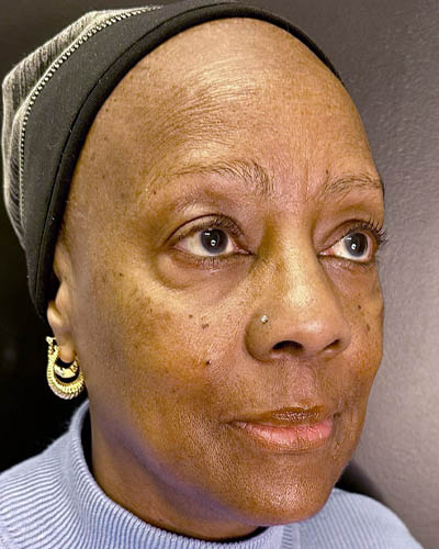 Facial Rejuvenation case #4879