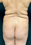 Butt Lift case #4673