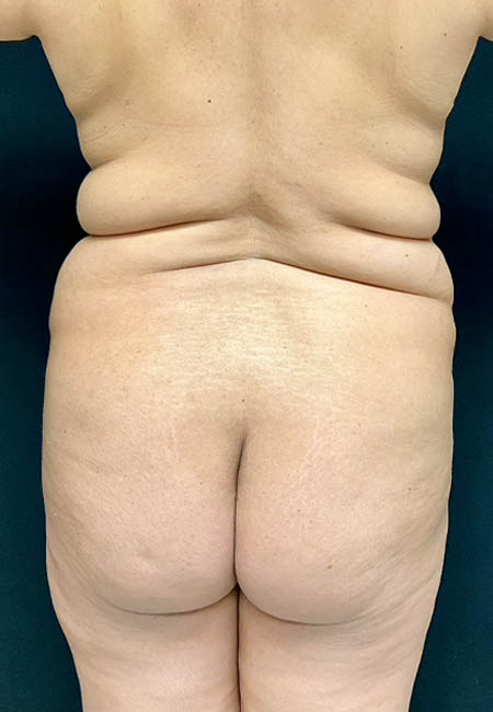 Butt Lift case #4673