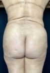 Butt Lift case #4673