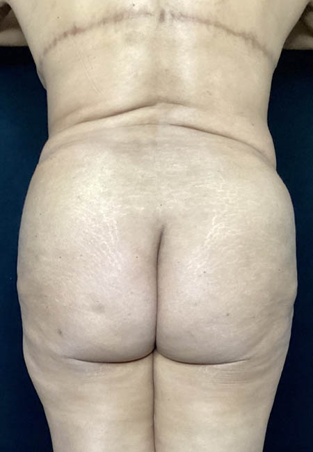 Butt Lift case #4673