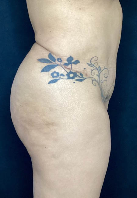Butt Lift case #4673