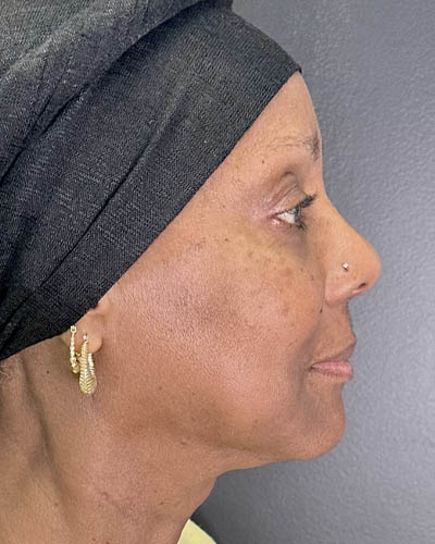 Facial Rejuvenation case #4879