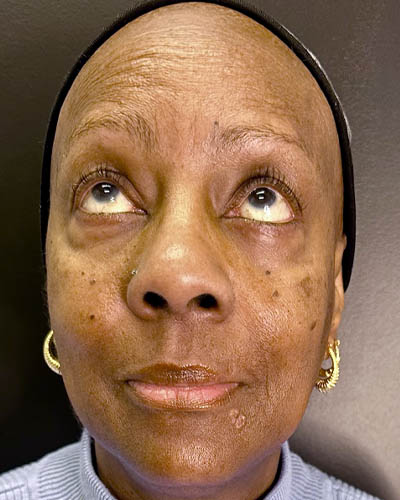 Facial Rejuvenation case #4879