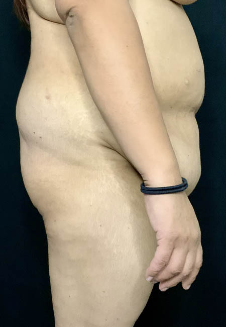 Butt Lift case #4684