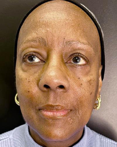 Facial Rejuvenation case #4879