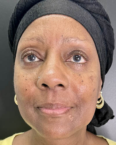 Facial Rejuvenation case #4879