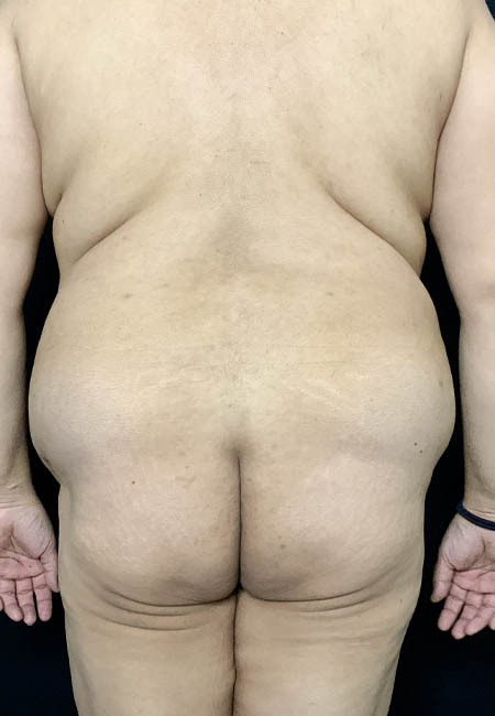 Butt Lift case #4684