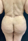 Butt Lift case #4684