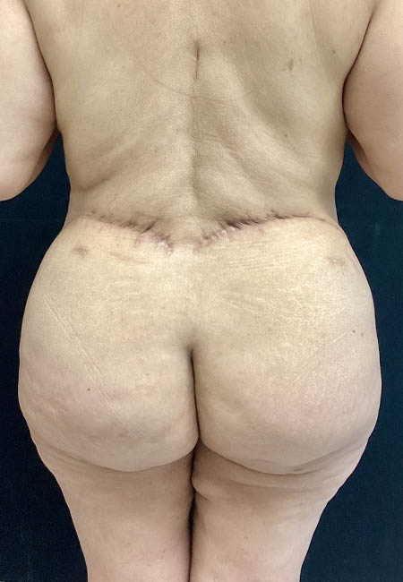 Butt Lift case #4684