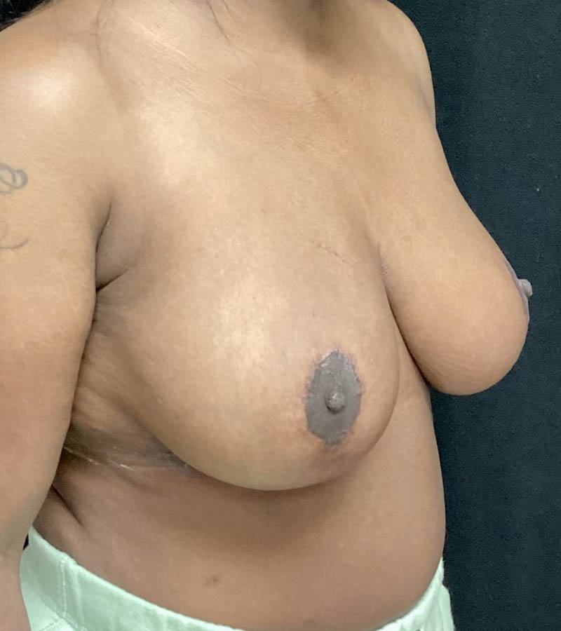 Breast Reduction case #4770