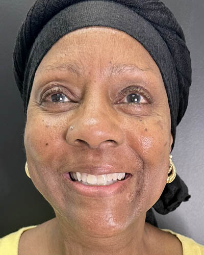 Facial Rejuvenation case #4879