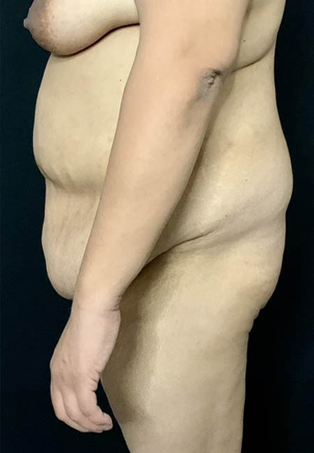 Butt Lift case #4684
