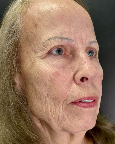 Blepharoplasty case #4804