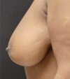 Breast Reduction case #4770