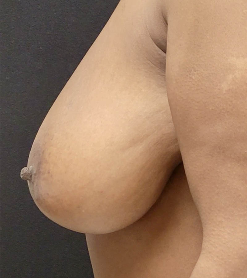 Breast Reduction case #4770