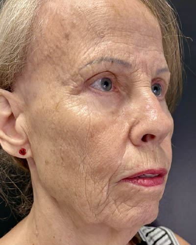 Blepharoplasty case #4804