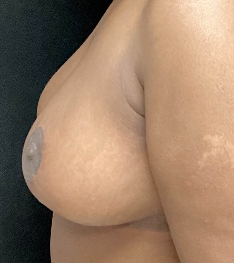 Breast Reduction case #4770