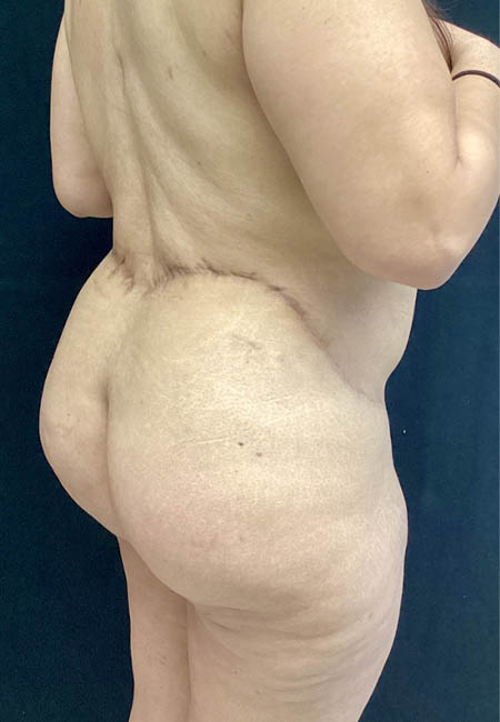 Butt Lift case #4684