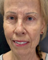 Blepharoplasty case #4804