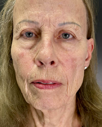 Blepharoplasty case #4804