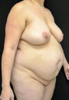 Tummy Tuck case #4695