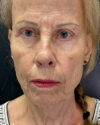 Blepharoplasty case #4804