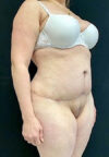 Tummy Tuck case #4695