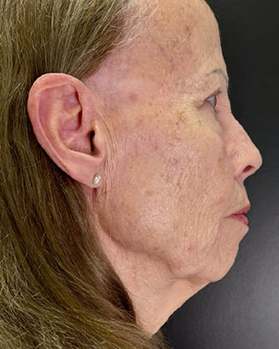 Blepharoplasty case #4804