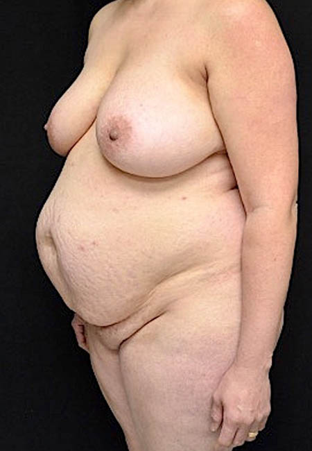 Tummy Tuck case #4695