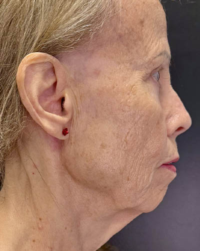 Blepharoplasty case #4804