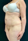 Tummy Tuck case #4695
