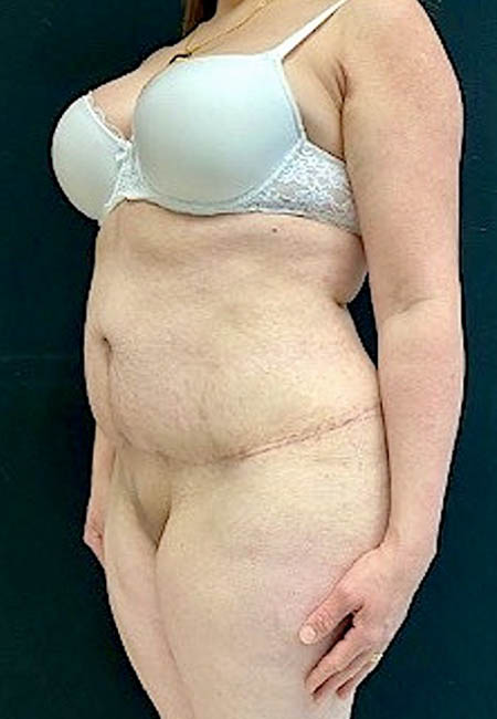 Tummy Tuck case #4695