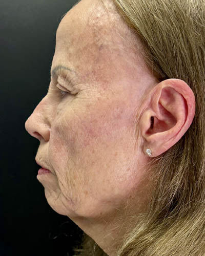 Blepharoplasty case #4804