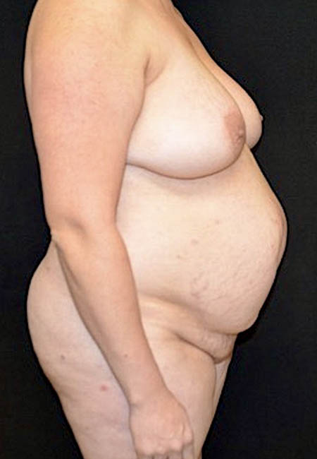 Tummy Tuck case #4695