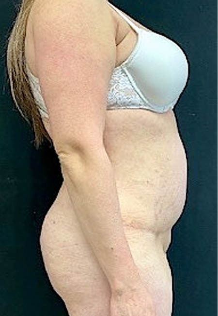 Tummy Tuck case #4695