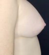 Breast Augmentation case #4759