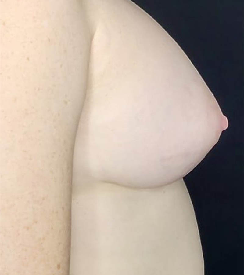 Breast Augmentation case #4759
