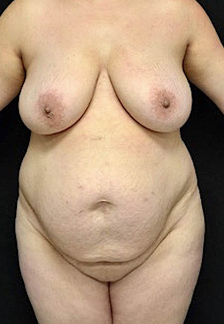 Tummy Tuck case #4695